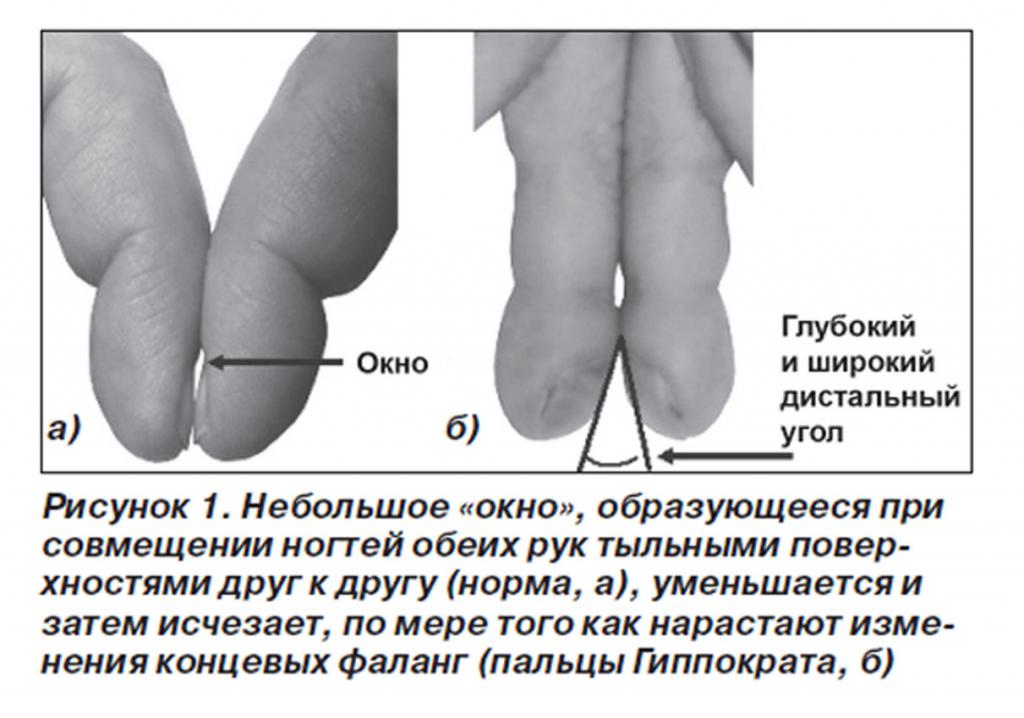 Утолщение ногтей