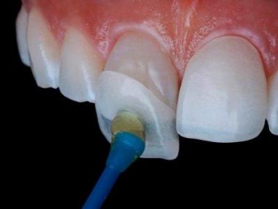 Как виниры влияют на здоровье зубов?