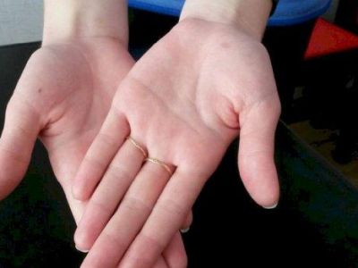 О каких заболеваниях можно догадаться по состоянию рук?