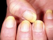 Ухудшение внешнего вида ногтей связано с рядом заболеваний